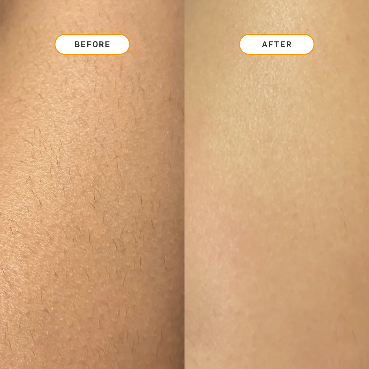 Before and after comparison showing visibly reduced hair growth on skin after using Nood The Eraser